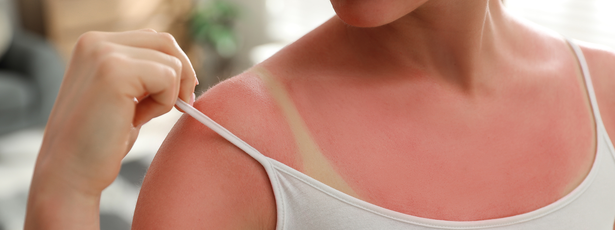 A woman shows sunburn line on shoulder
